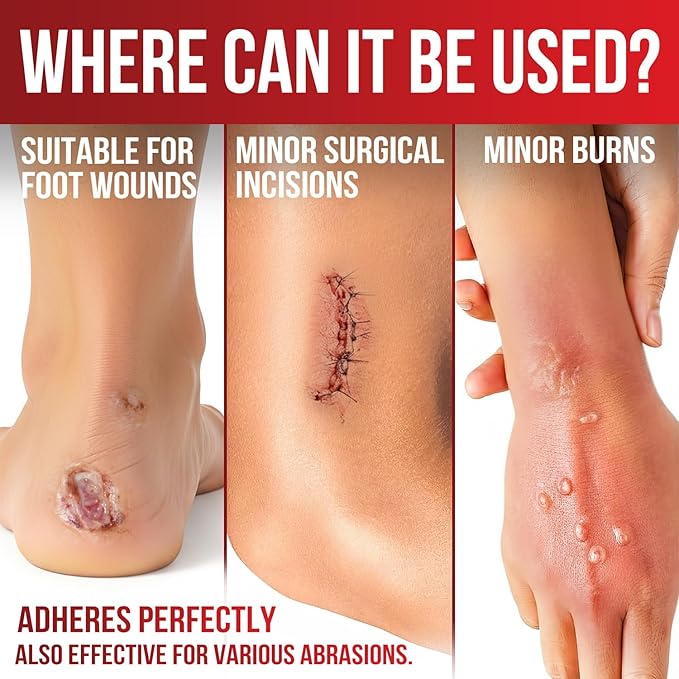 FRESINIDER Large Sacrum Silicone Foam Dressing 6" x 6", 10 Pack – Super Absorbent Silicone Border Dressing for Bed Sores, Sacral Pressure Ulcers & Post-Surgery Care – Waterproof, Breathable & Gentle